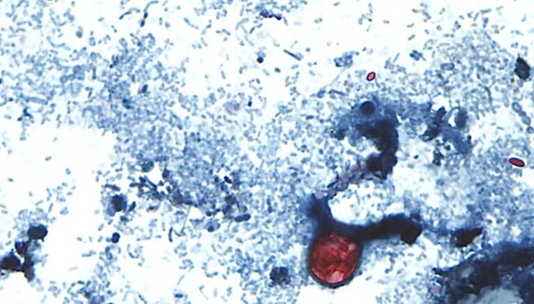 What is cyclosporiasis and how can you avoid catching this, uh, ‘explosive’ GI illness?